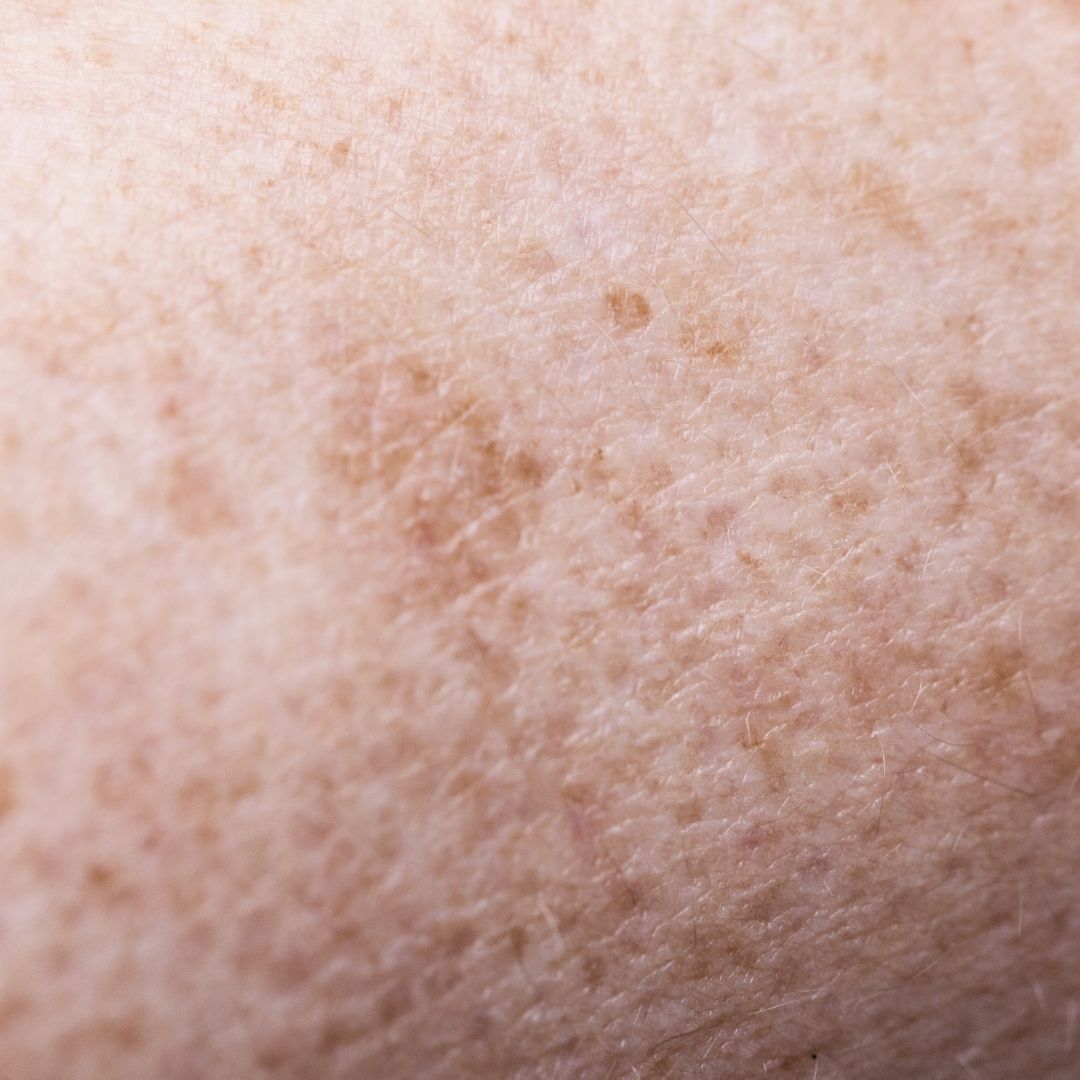 Hyperpigmentation