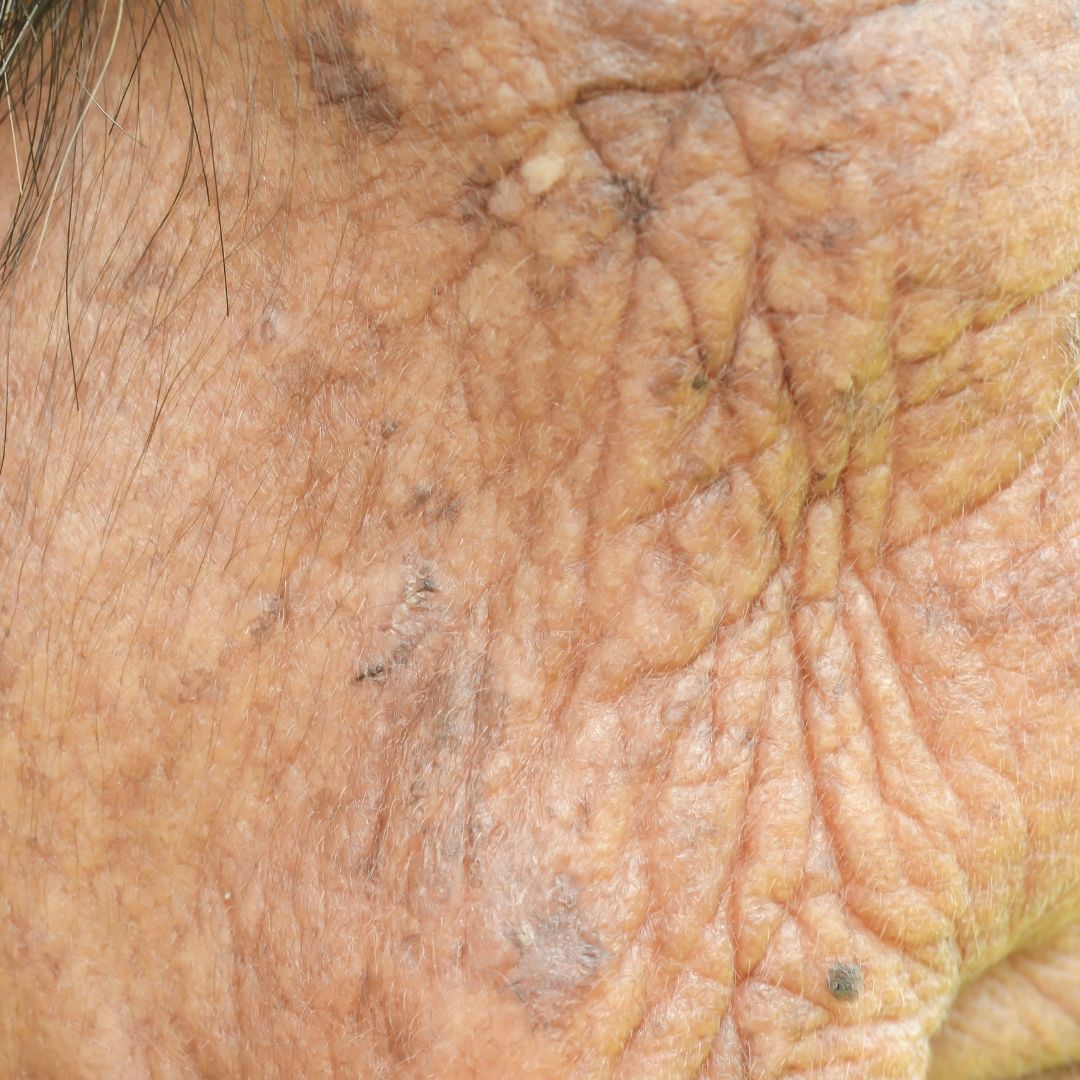 Aging