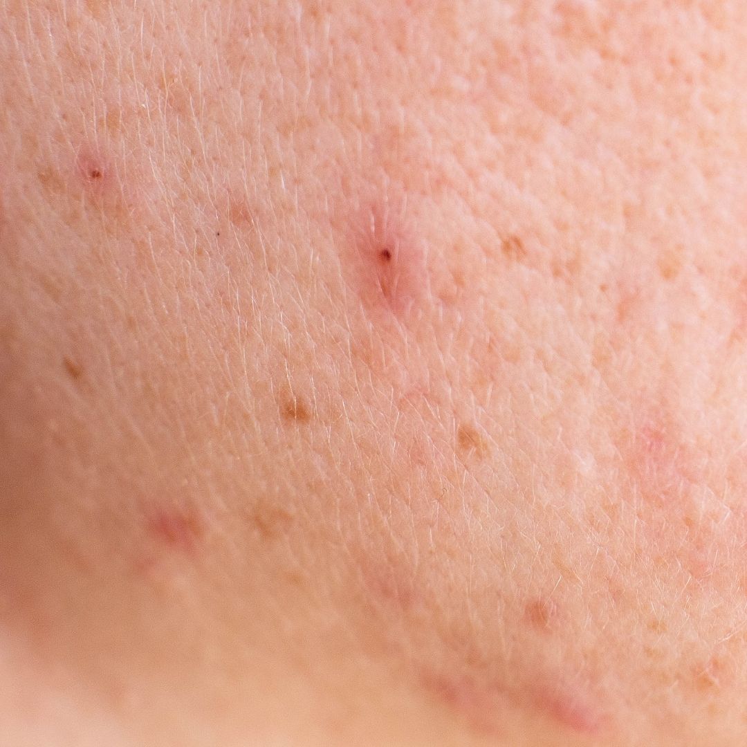 Acne-prone